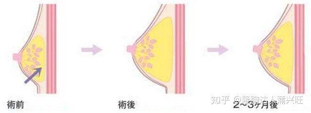 最新隆胸方法探索，现代丰胸技术的奥秘与揭秘